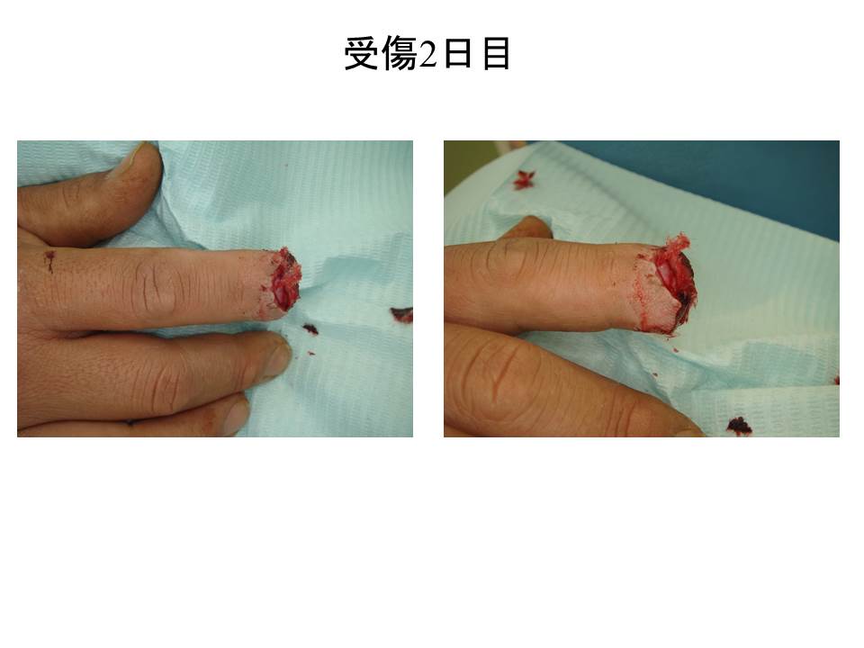 40歳男性 右第二指指尖部切断 ケガやヤケドの治療 粉瘤などの小手術について 湿潤治療のやりかた Asouiin